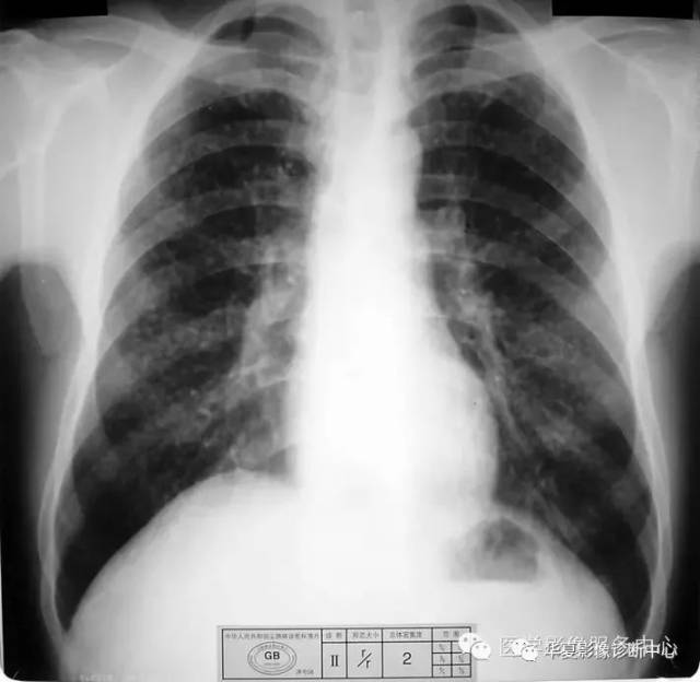 一期尘肺病ct片图片图片