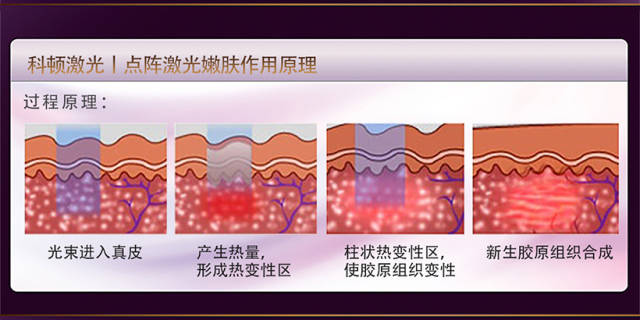 1,从点阵激光原理来说,它是采用新型co2激光局部疗法,应用co2激光能量