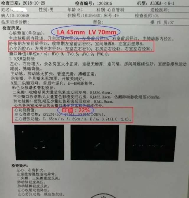 我院心血管科二病区成功开展首例严重心力衰竭心脏再同步复律除颤器