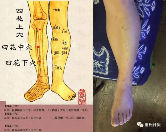 【穴位位置图【四花,门金,土水,下三皇】临床上全部单侧取穴,左右