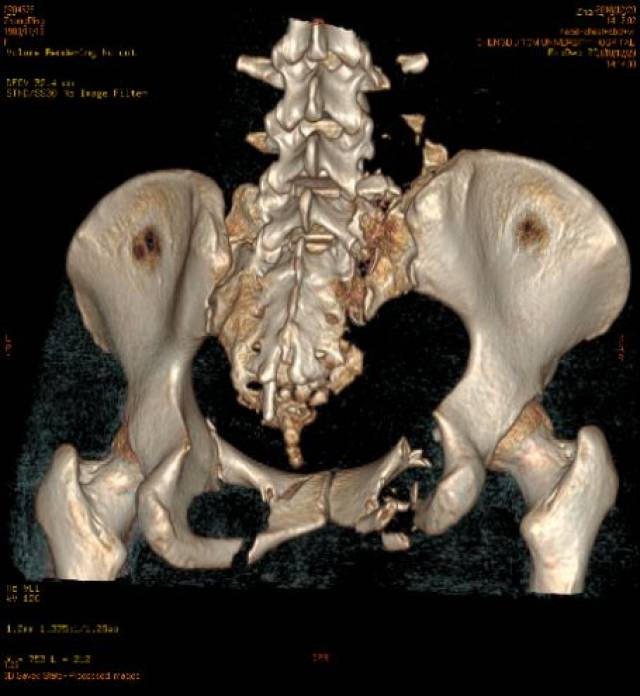 骨盆也有多處骨折:雙側骶翼,右側恥骨上下支及多個骶,尾椎骨粉碎骨折