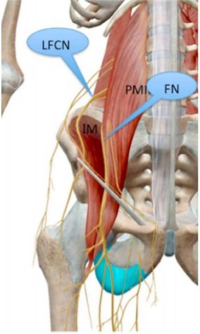 和股外側皮神經(lfcn)穿過左側腰大肌(pmm)和髂肌(im)之間的筋膜平面