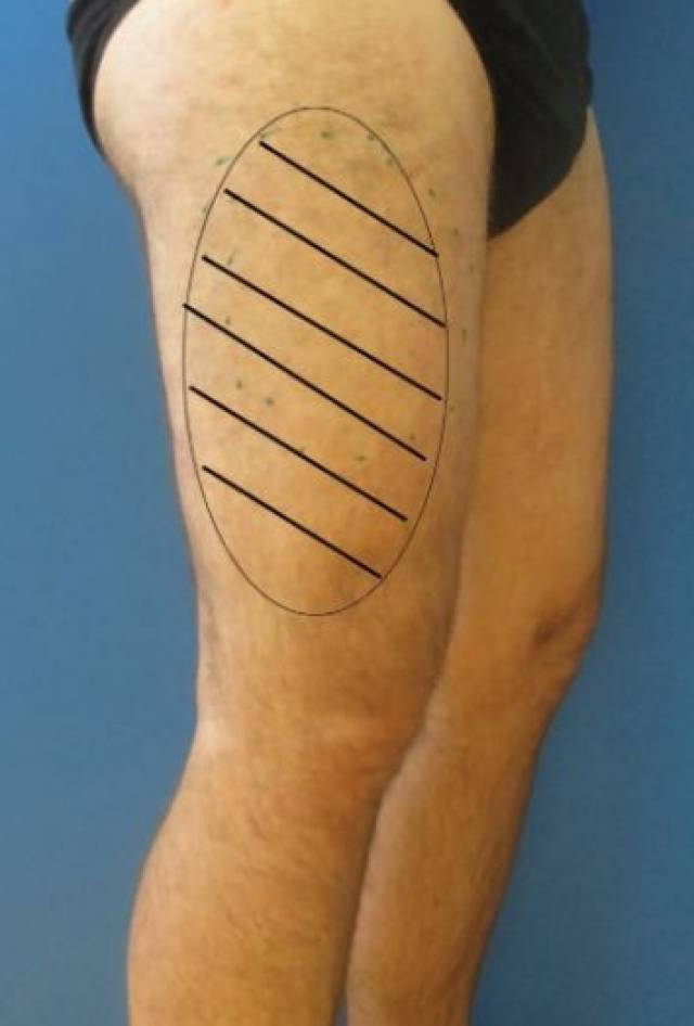 大腿外侧疼痛别忘了股外侧皮神经炎