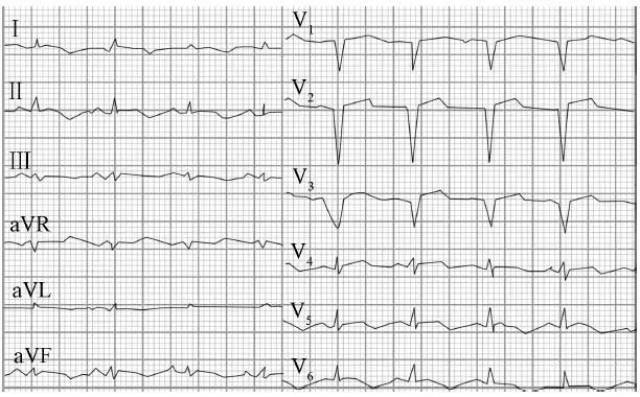 st段压低心电图图片