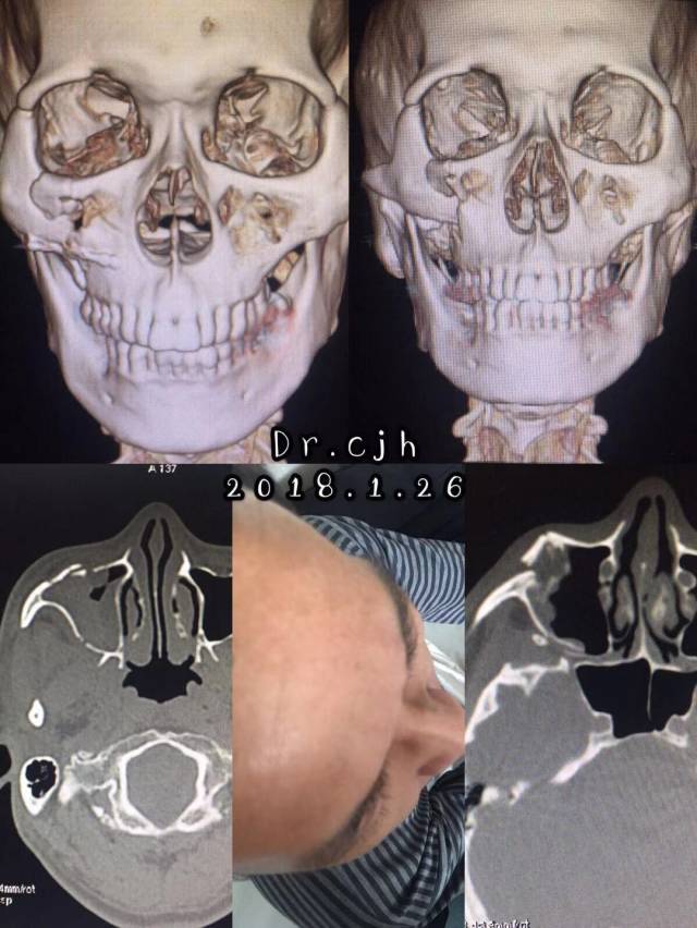 患者,男,50岁,摔伤导致右侧颧骨上颌骨,伴右侧颧骨较左侧明显塌陷,无