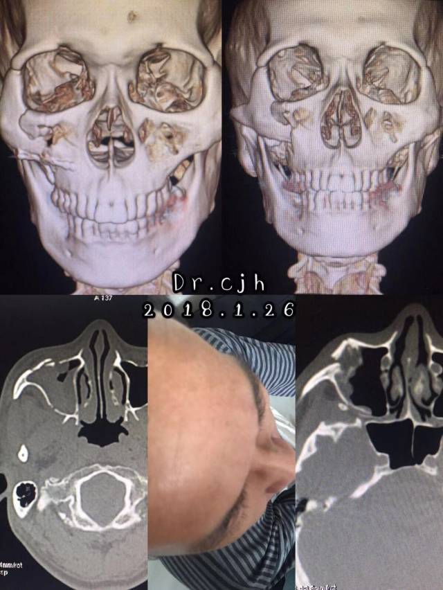 颧上颌复合体骨折修复术