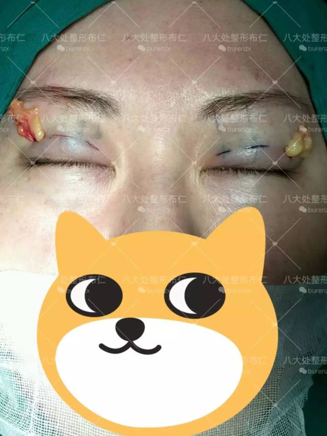 双眼皮手术不是简单的一条线,一道褶儿~(附案例) (原创)