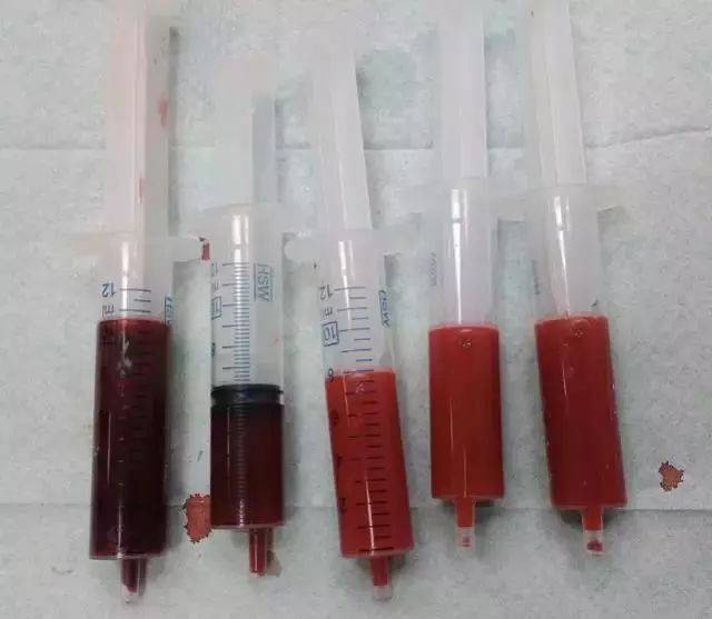 人的静脉血(左1,2)和动脉血(右1,2,3) 另类的代谢物颜色 有些时候