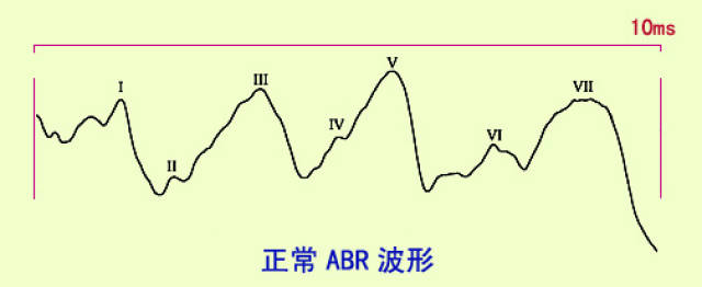 江阴惠耳听力提示脑干听觉诱发电位在临床上的应用