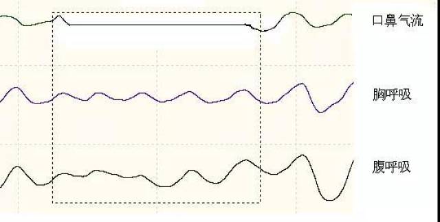 阻塞型睡眠呼吸暂停与正常的呼吸运动趋势图对比