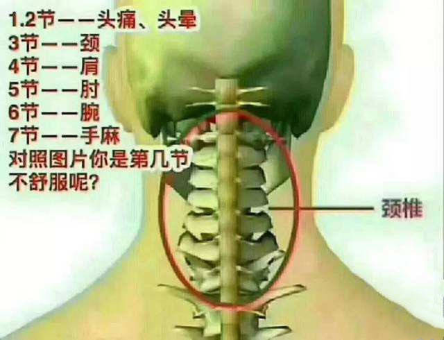 6,食管压迫型颈椎病:吞咽困难(经食管钡剂检查证实).