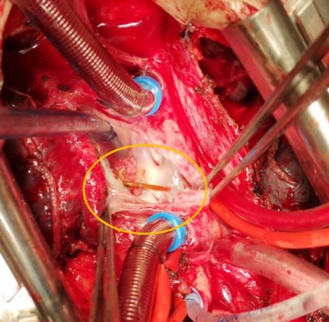 异物 原来,小周将牙签误吸入气道后进入右肺,随着呼吸运动及心脏跳动