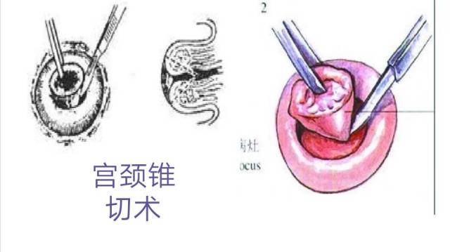 宫颈锥切术图片大全图片