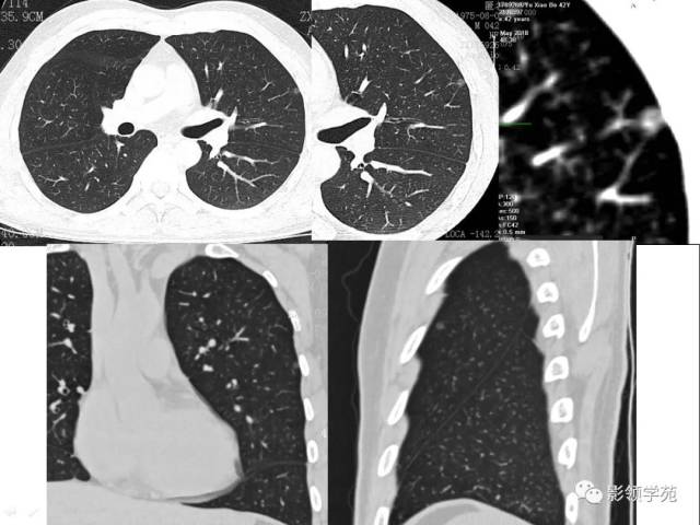 ct征象对早期肺腺癌分型之胸膜凹陷征