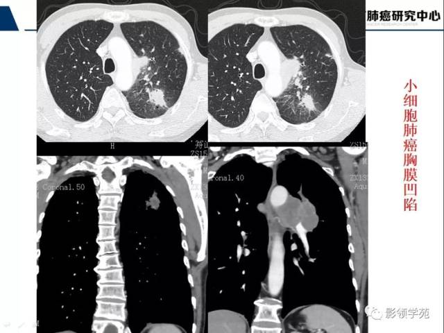 ct征象对早期肺腺癌分型之胸膜凹陷征