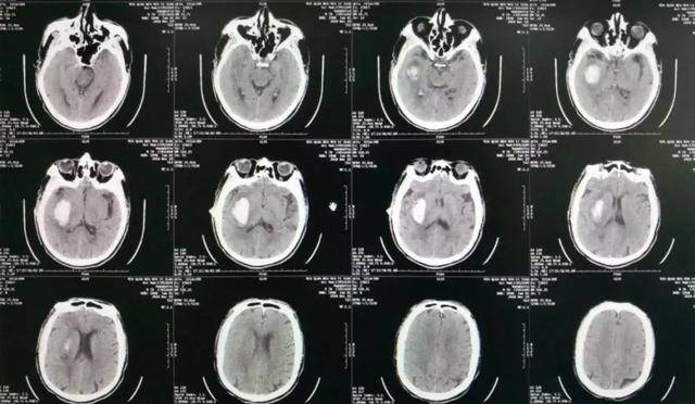 無力,言語不清,伴頭痛,頭暈,入院後行顱腦ct檢查示:右側基底節區腦