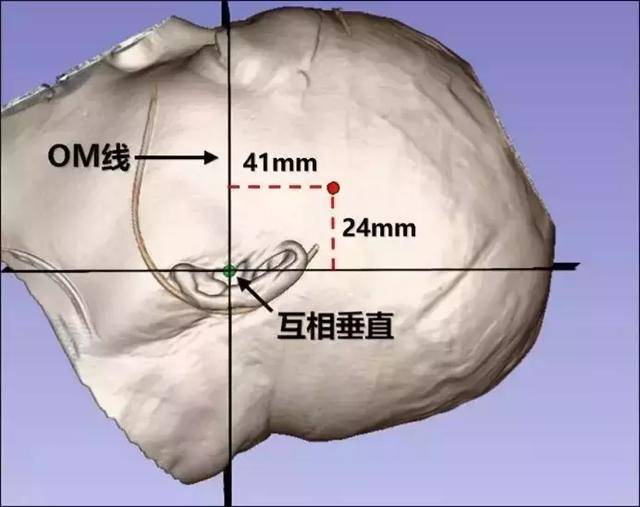 头颅前后半轴位图片图片