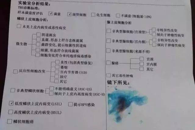 tct宮頸篩查,你定期檢查了嗎?