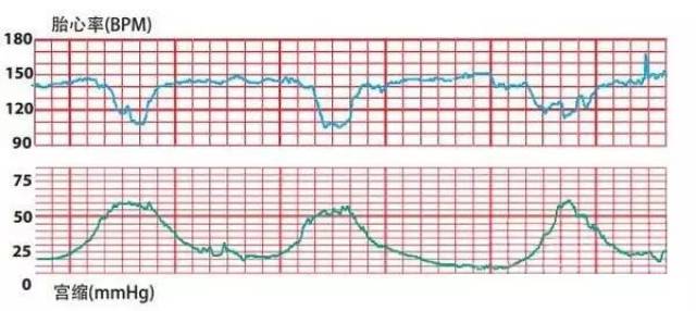 胎心减速图什么样子图片