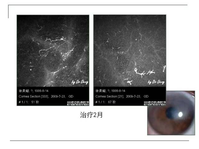 微观,妙不可言—激光共聚焦显微镜下的感染性角膜病