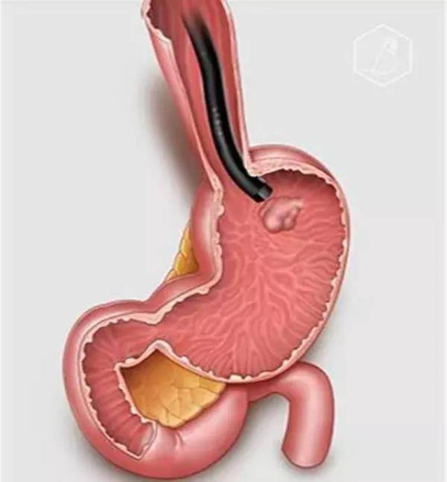 胃肿大的腹部图片图片