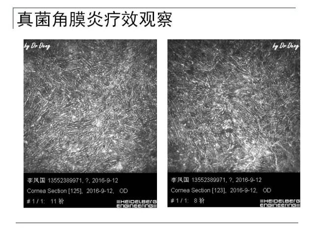 微观,妙不可言—激光共聚焦显微镜下的感染性角膜病