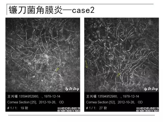 微观,妙不可言——激光共聚焦显微镜下的感染性角膜病