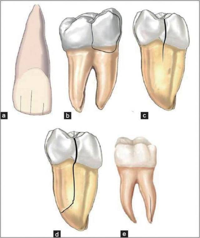 牙根纵裂的诊断—刘学军教授