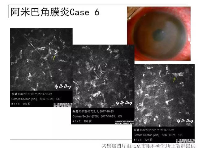 微观,妙不可言——激光共聚焦显微镜下的感染性角膜病