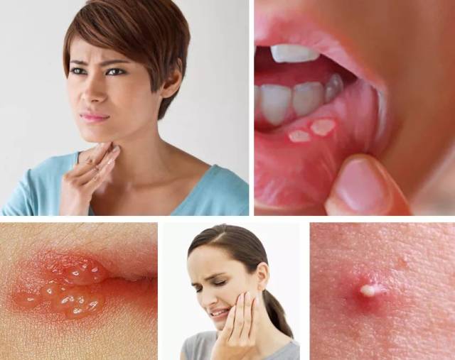 反应在身体上最直观的就是,早起嗓子干,经常会出现咽喉肿痛,耳鸣目赤