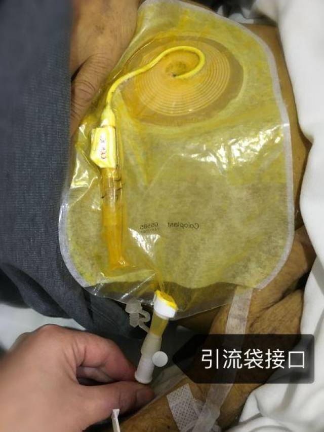 造口袋接引流渗液违反无菌?试试这个方法