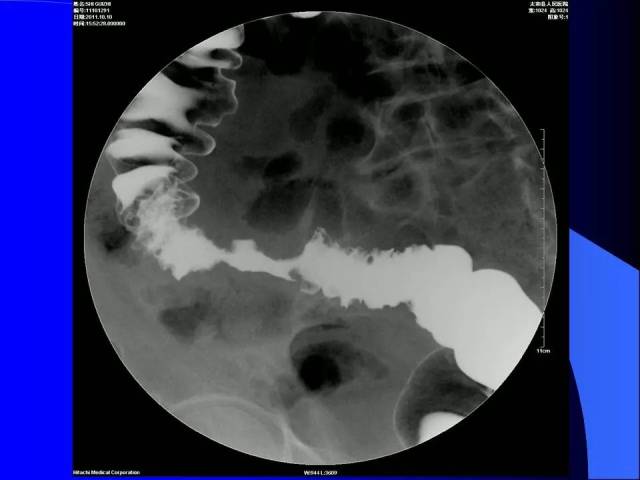 结肠癌x线图片图片