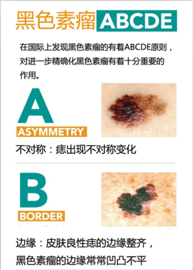 可能癌變的黑痣,到底長啥樣? (原創)