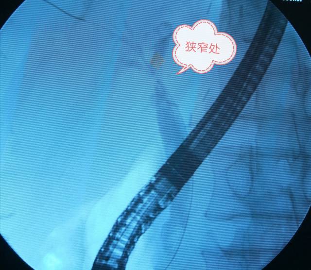 胆管支架取出图片