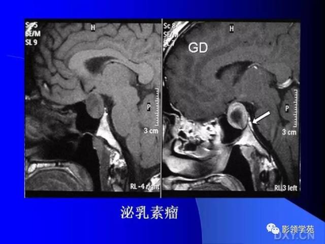 垂體瘤的mri診斷及鑑別診斷_手機搜狐網