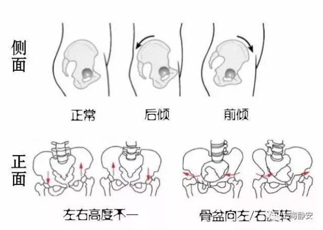 盆骨前倾侧面骨图图片