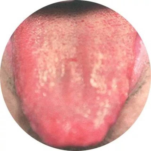 暗红舌,苔黄微腻