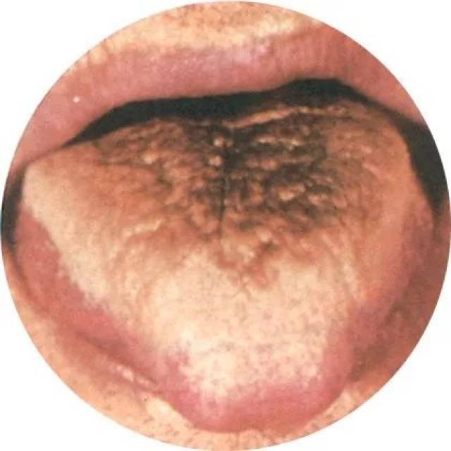 【中医康复】一文学会舌诊