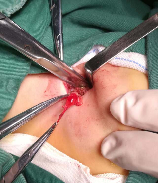甲舌囊肿手术图片