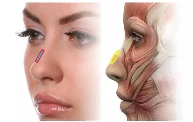 肉毒素和玻尿酸的正确注射方法和解析(中面部篇) (原创)