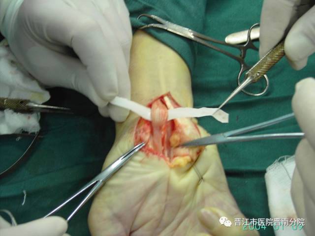 关节僵硬可能腕管综合征治疗方法包括:有保守治疗(局部封闭)及手术