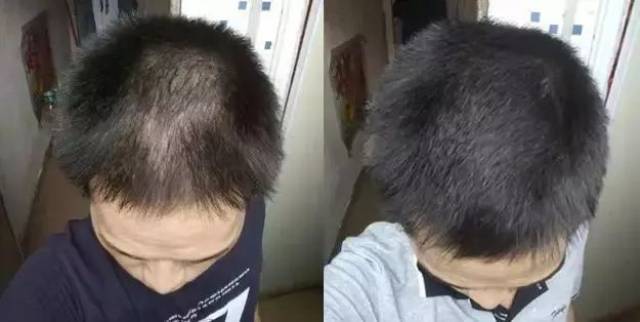 00后也开始脱发了?该怎么拯救你,我的头发?