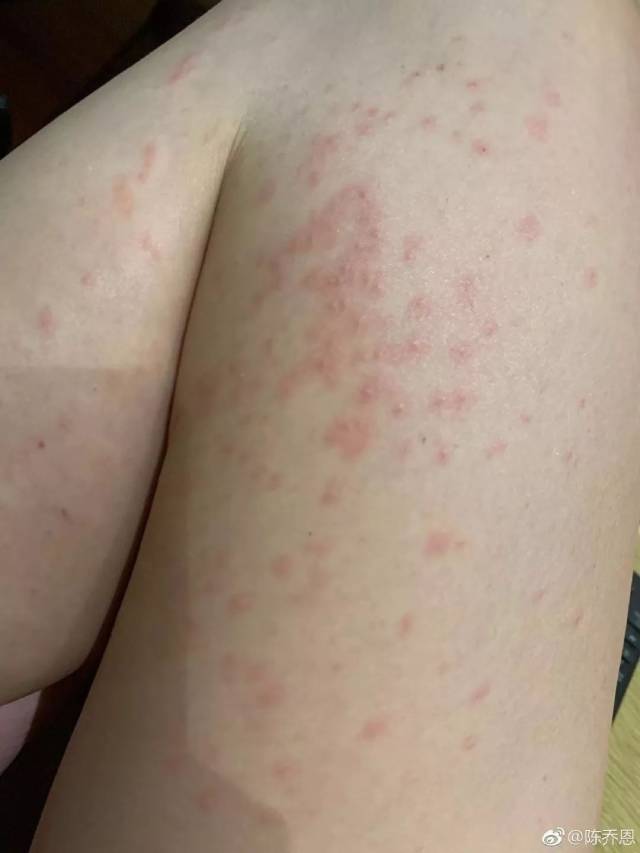陈乔恩肌肤过敏出红疹太吓人!换季时候,这9件日本宝贝保你白白嫩嫩!