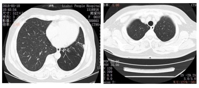 ct影像:2002年左肺上葉腫瘤術後隨訪穩定.