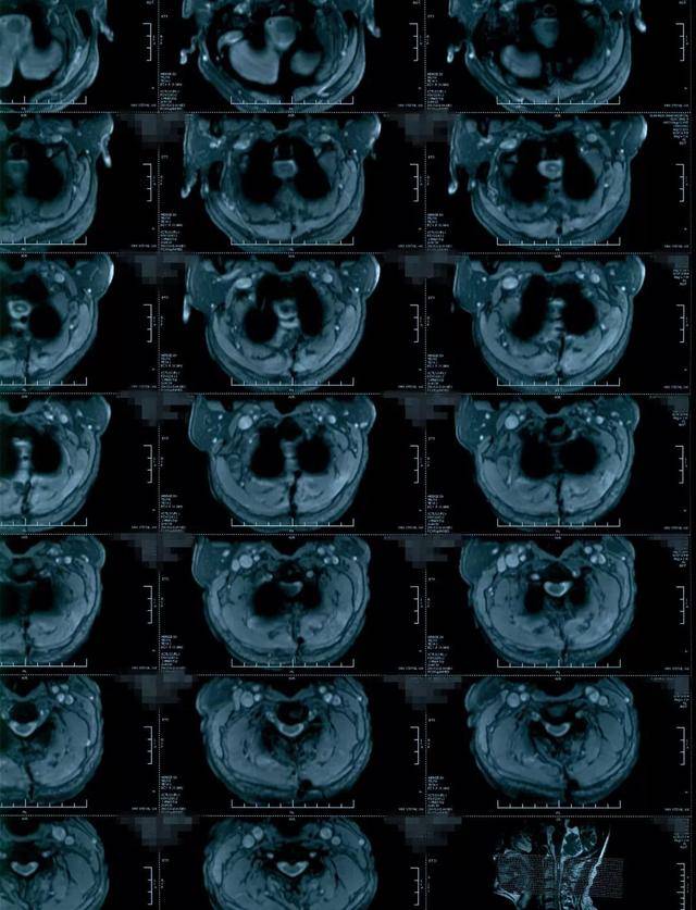 颈椎室管膜瘤图片