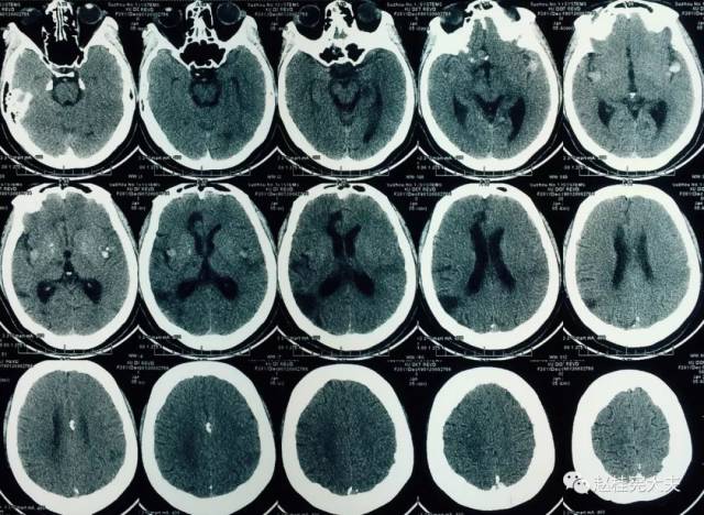 脑袋里的这么多瘤瘤竟然跟心脏有关(⊙o⊙)_手机搜狐网