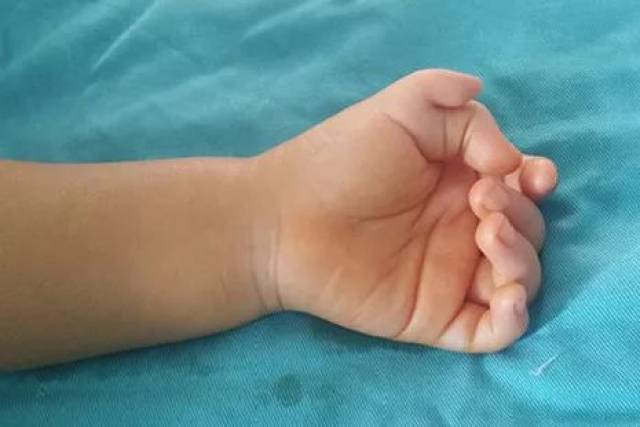 【沧州二院】六指"真的不吉利吗?2岁前手术最好