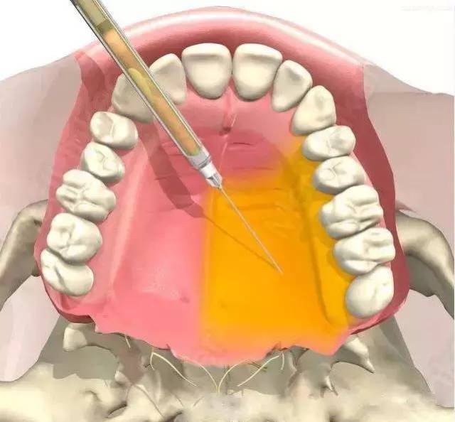 口腔医师必须知道的麻醉方法,麻醉药物及注意事项!