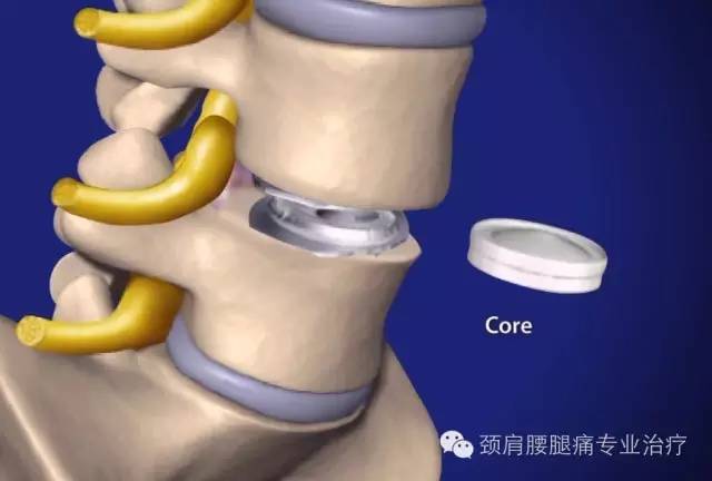 人工椎间盘图片