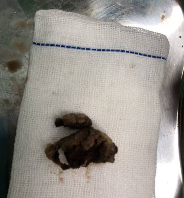 【医疗动态】6岁女童阴道塞异物 西安市第一医院腔镜解难题_手机搜狐